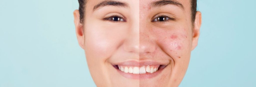 Korean moisturizers for acne-prone skin
